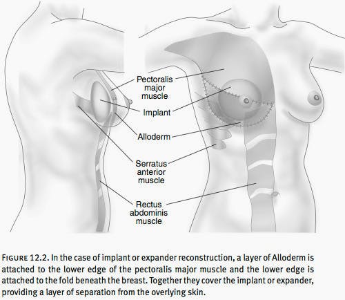 Breast reconstruction - series—Aftercare: MedlinePlus Medical Encyclopedia